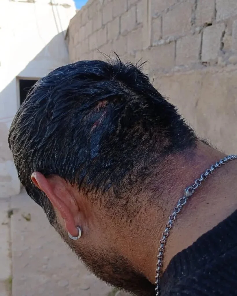 Agresión en barrio Santa Celia: mujer utiliza botella contra su expareja